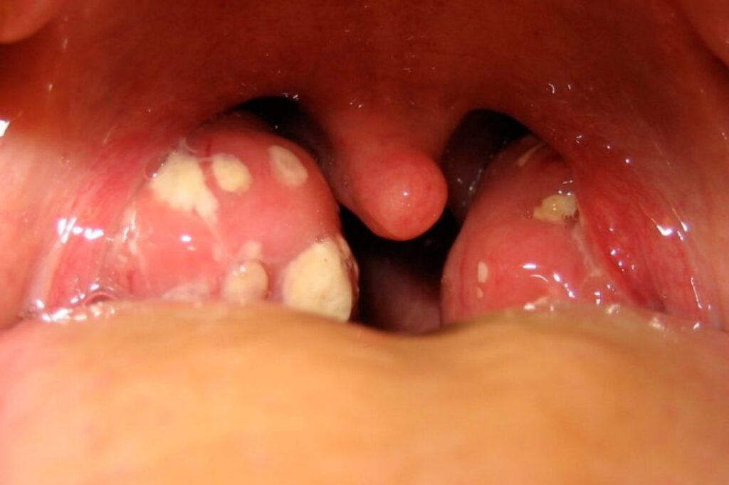 Infezione batterica alla gola