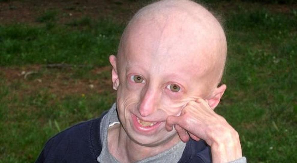 Sindrome Progeria