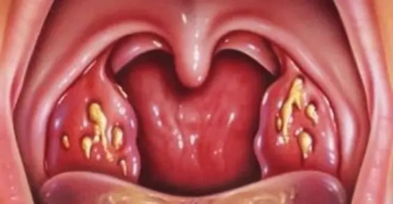 Infezione alle tonsille