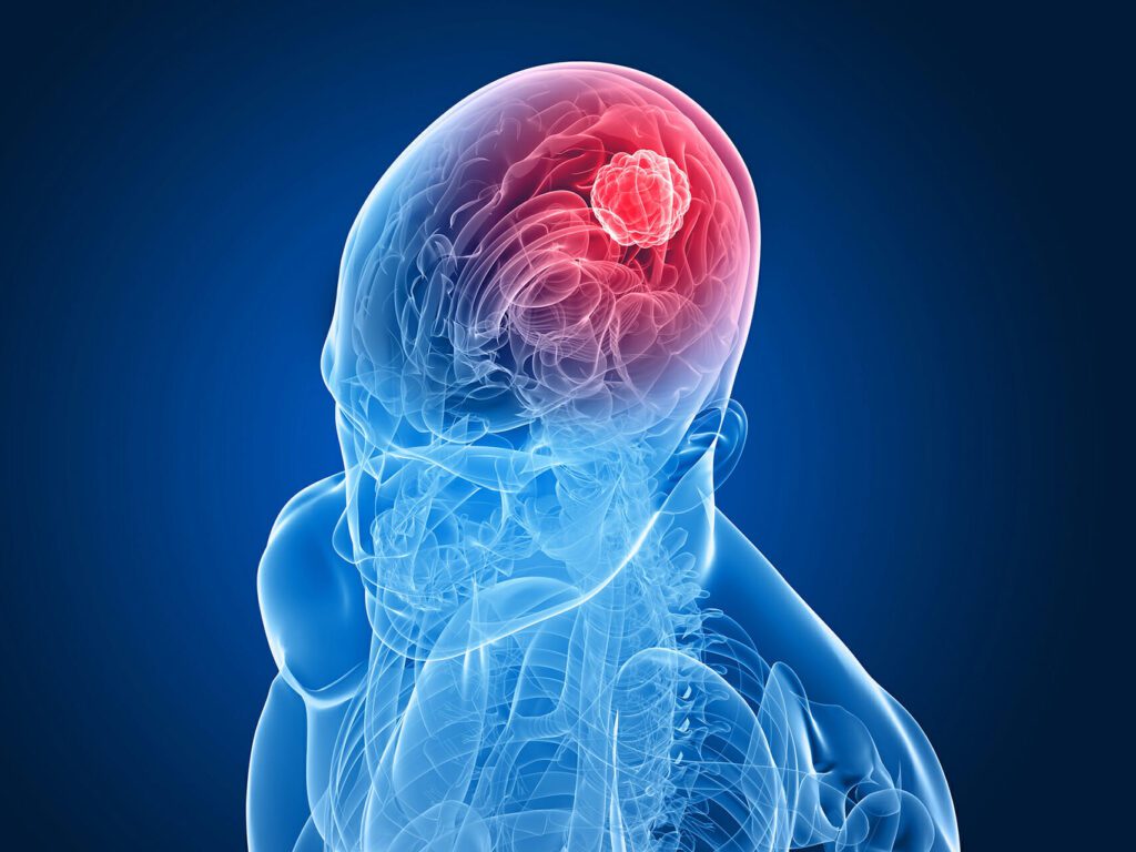 Tipi di tumori Cerebrali
