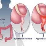 Appendicite Cause