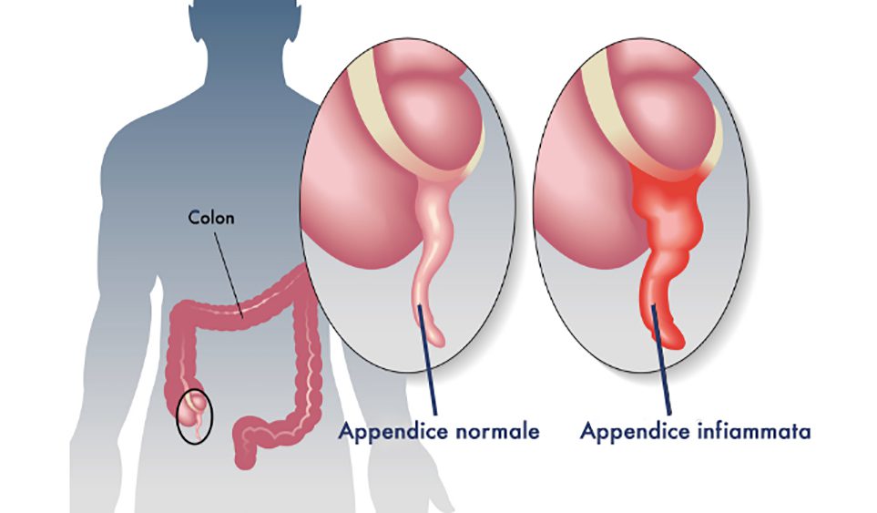 Appendicite Cause