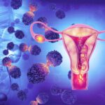 Cura del Tumore alla Cervice Uterina