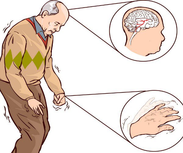 Diagnosi del Morbo di Parkinson