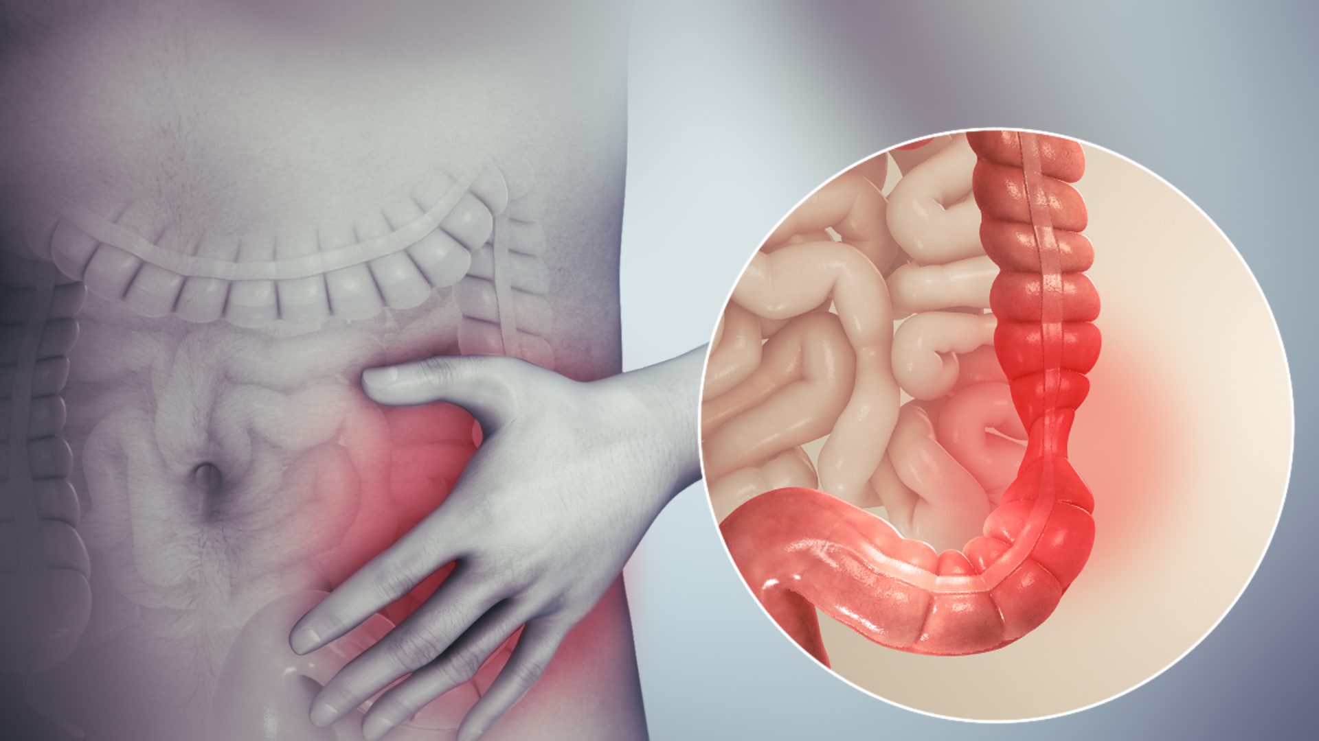 Dieta Sindrome del Colon Irritabile