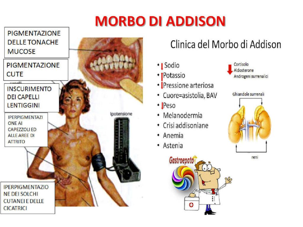 Morbo di Addison