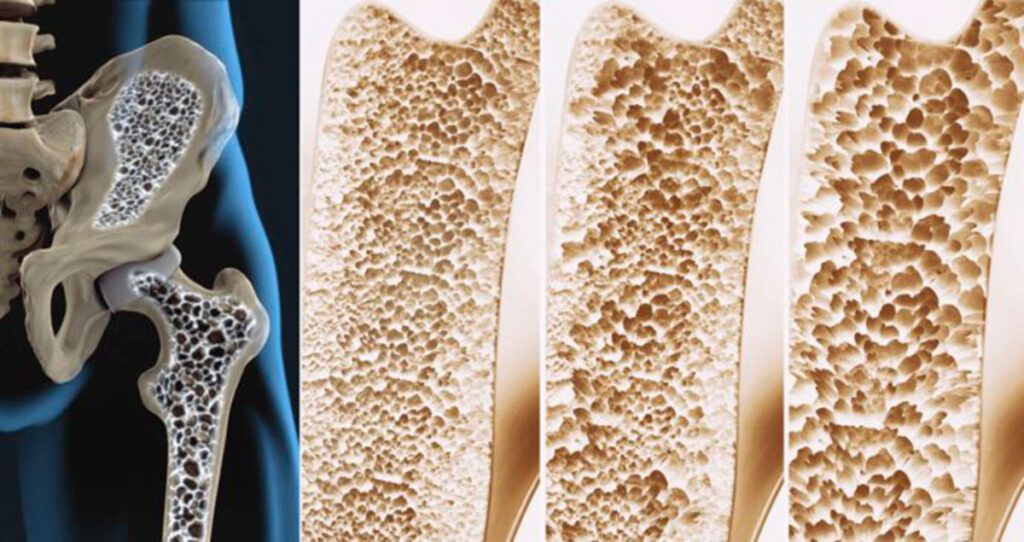 esercizio fisico osteoporosi