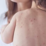 La Vaccinazione Contro la Varicella