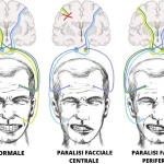 Paralisi Facciale