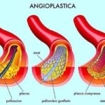 Angioplastica con Stent