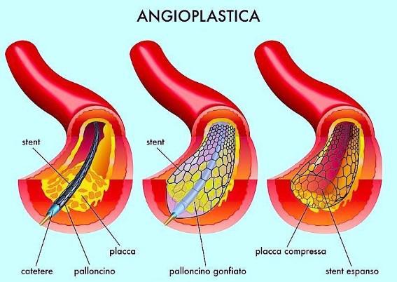 Angioplastica con Stent