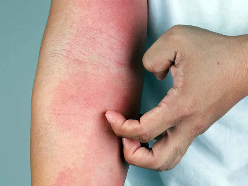Come Riconoscere Dermatite da Sudore