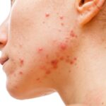 Retinoidi per Acne