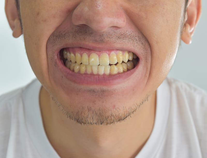 Denti Ingialliti