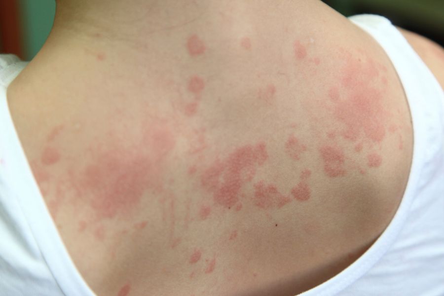 Quali sono i primi sintomi di un'allergia?