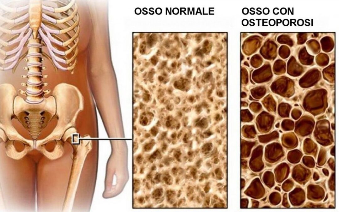 Chi ha l'osteoporosi ha dolori?
