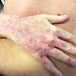 Come capire se è allergia o dermatite?