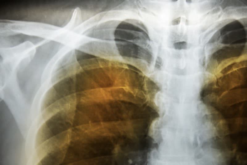 Come convivere con un enfisema polmonare?