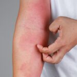 Come si riconosce un'allergia sulla pelle?
