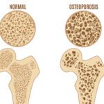 Qual è il rischio principale dell'osteoporosi?