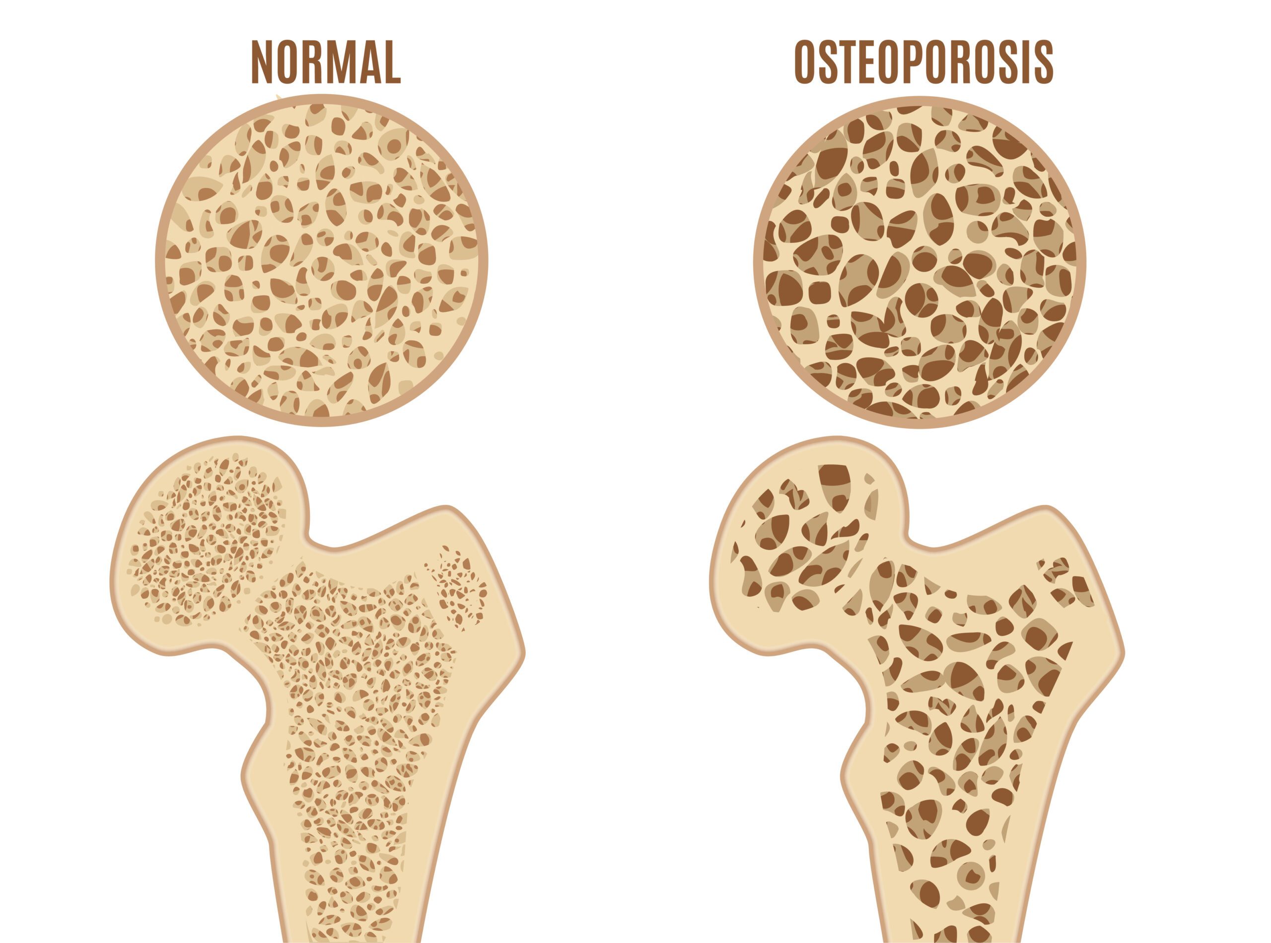 Qual è il rischio principale dell'osteoporosi?