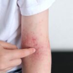 Quanti giorni dura una dermatite?