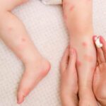 Come capire se è dermatite o allergia?