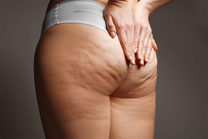 Due Sport per Combattere la Cellulite