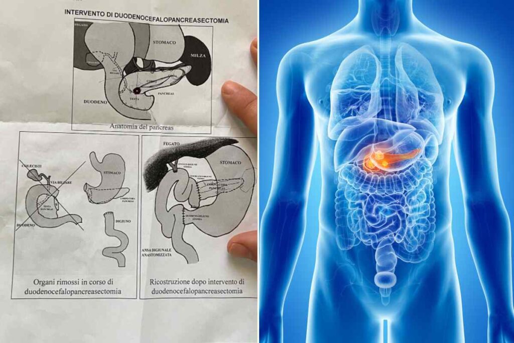 tumore neuroendocrino pancreas