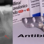 Antibiotico per Denti