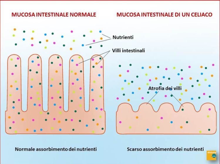 diabete di tipo I e celiachia