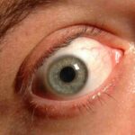 Quali sono i primi sintomi del glaucoma?