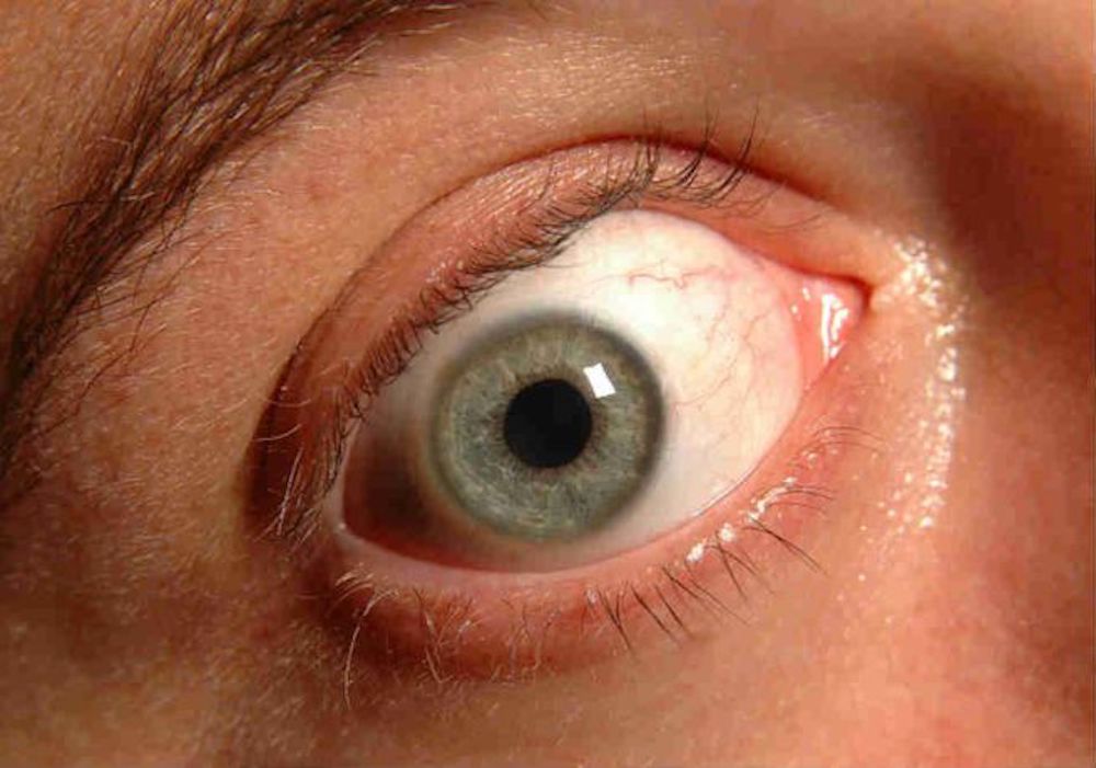 Quali sono i primi sintomi del glaucoma?