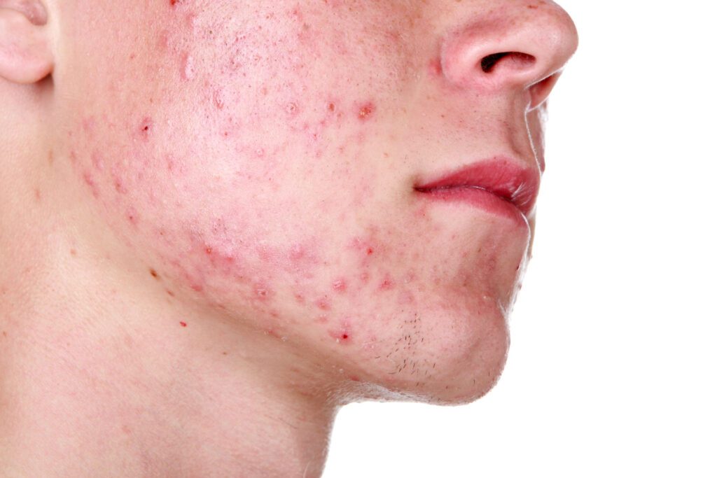 Acne e Trattamenti Innovativi