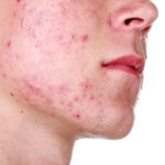 Acne e Trattamenti Innovativi