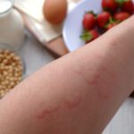 Come capire se si è allergici al cibo?