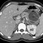 Pancreatite acuta sintomi poco comuni