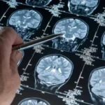 Biomarcatori per la Malattia di Alzheimer